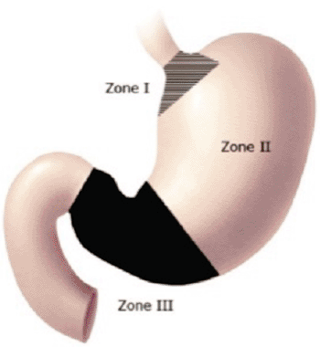 Imagen: Clasificaciones de zonas estomacales para TGIS, determinadas por los investigadores (Fotografía cortesía del Hospital Universitario Thomas Jefferson).